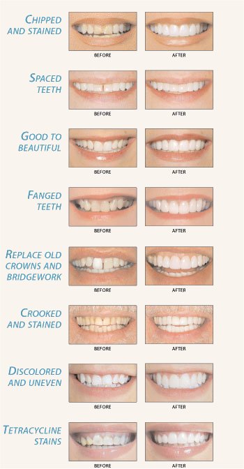 before after smile pics